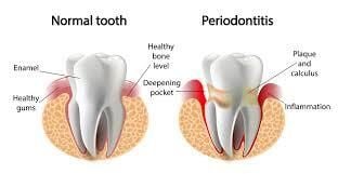 Periodontal Disease Periodontal Disease